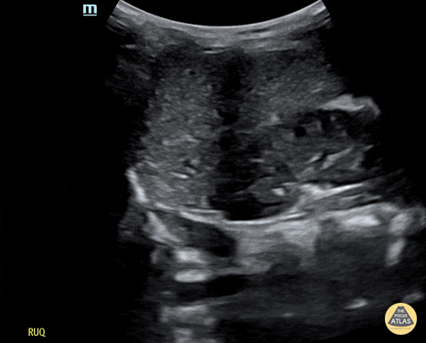 Trauma - Normal RUQ Evaluation