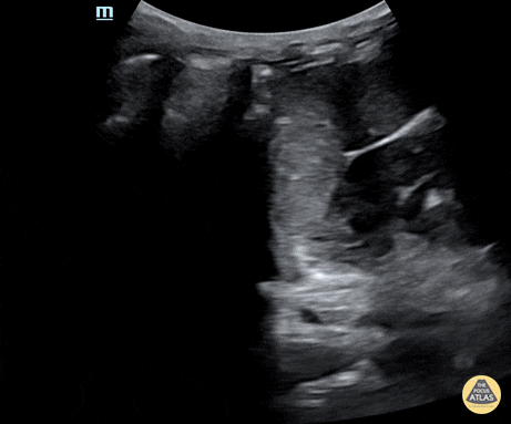 Trauma - Normal LUQ Evaluation