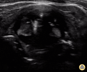 Peds-Lung - Esophageal Intubation