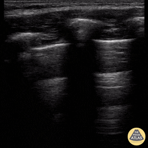 Peds-Lung - Normal Lung Sliding During FAST Exam