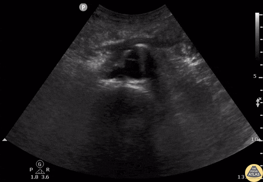 Aorta - Saccular AAA with Dissection Flap