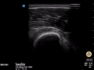 Peds-MSK - Humerus fracture- short axis (2/2)