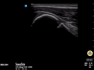 Peds-MSK - Humerus fracture- long axis (1/2)