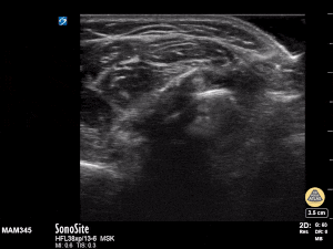 Peds-MSK - Radius/ Ulna Fracture Transverse (1/2)