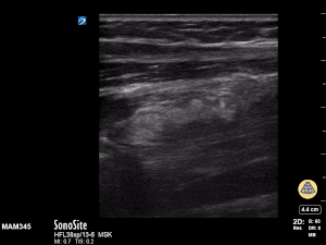 Peds-MSK - Radius/Ulnar fracture Long Axis (1/2)