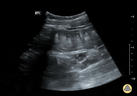 Bowel-GI - To & Fro Peristalsis in Bowel Obstruction
