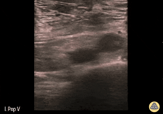 Vascular - Occlusive DVT of the Left Popliteal Vein