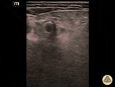 Vascular - Femoral Artery Stent