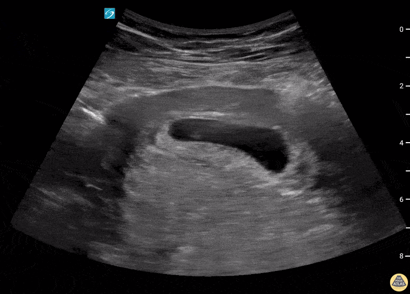 OB/Gyn - Dichorionic Diamniotic Twin Intrauterine Pregnancy