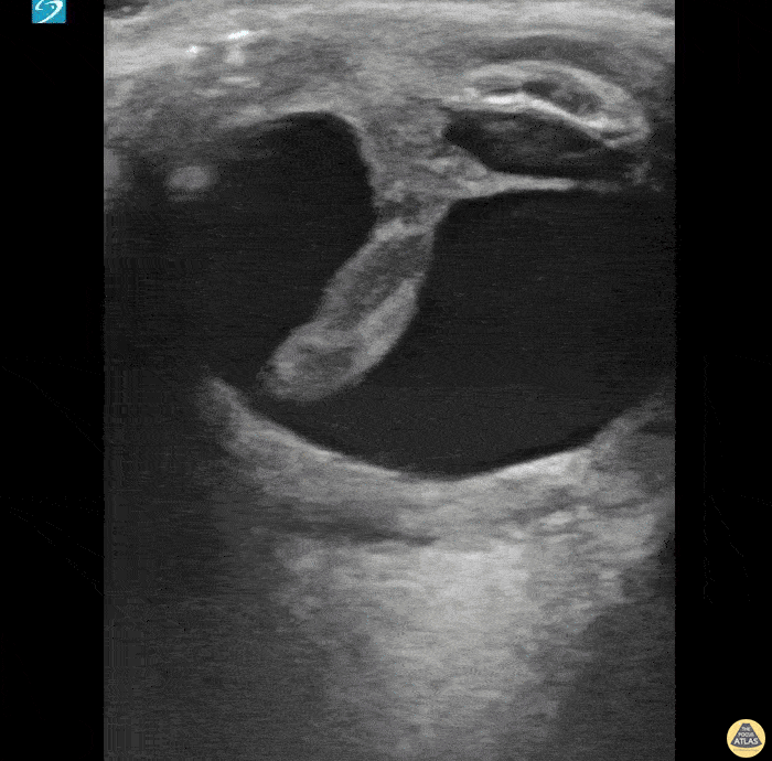 Orbital - Old Globe Rupture