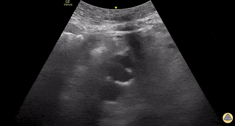 Aorta - Aortic Dissection Flap in Desceding Aorta