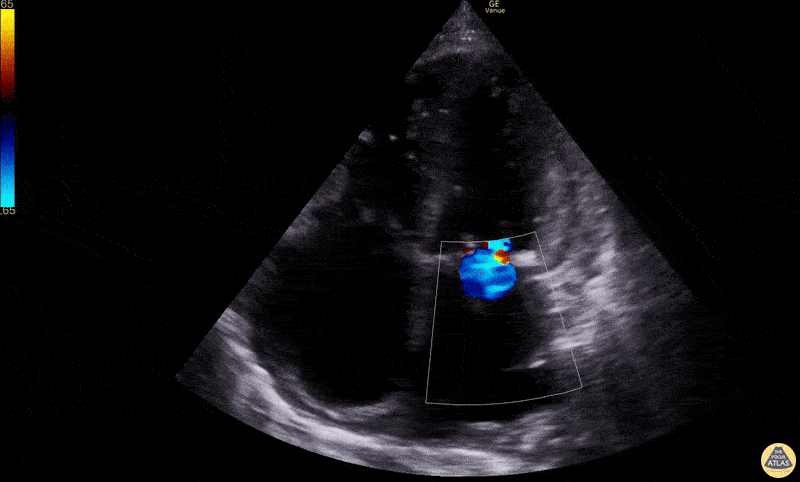 Valvulopathy - Mitral Regurgitation Jet