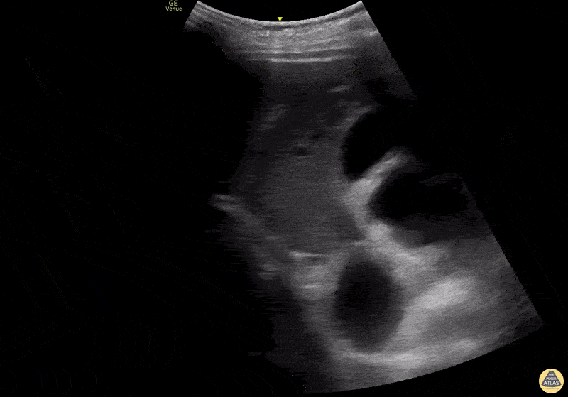 Bowel-GI - Tanga Sign (SBO)