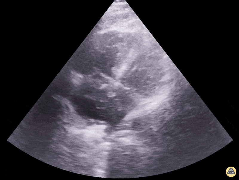 Right Ventricular Dysfunction - McConnell Sign with RV Enlargement