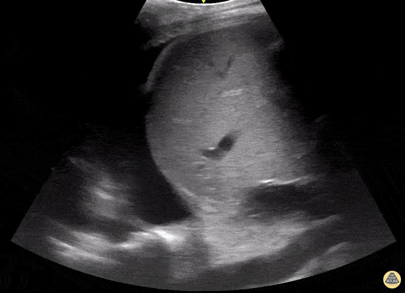 Pulmonary - Pleural Effusion with Compressed Lung and Spine Sign
