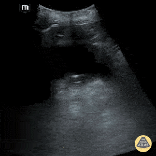 Renal/GU - Bladder Diverticulum 2
