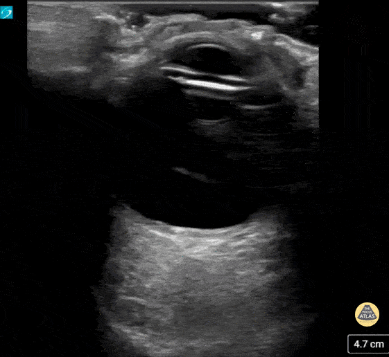 Orbital - Prosthetic Ocular Lens Subluxation