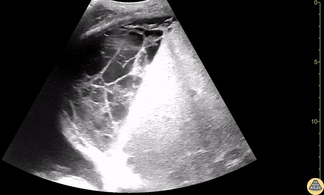 Biliary - Loculated Collection Within Liver