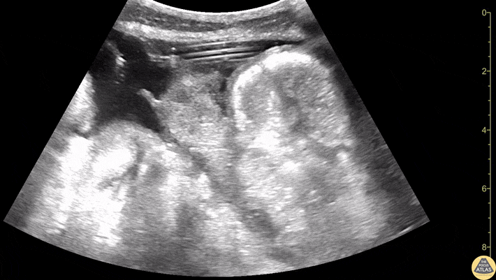 Biliary - Drainage Tube Within Loculated Liver Collection
