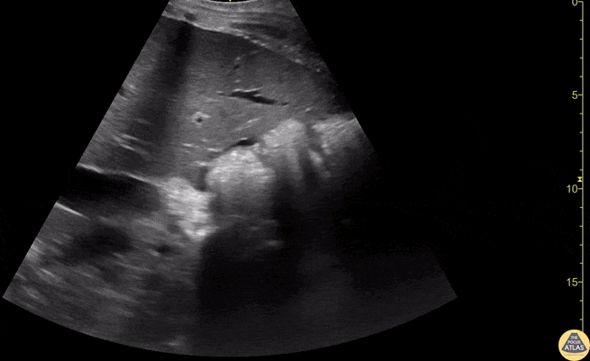 Bowel-GI - Free Fluid at Liver Tip