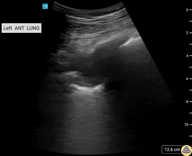 Pulmonary - Lung Cavitary Lesion