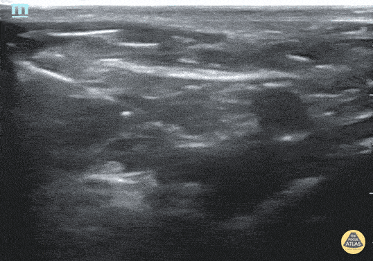 Peds-Nerve Blocks - Fascia Iliaca Nerve Block