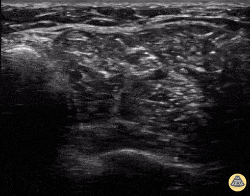 Peds-Nerve Blocks - Posterior Tibial Nerve Block Lidocaine Infiltration