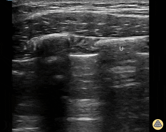Peds-Nerve Blocks - Serratus Anterior Block