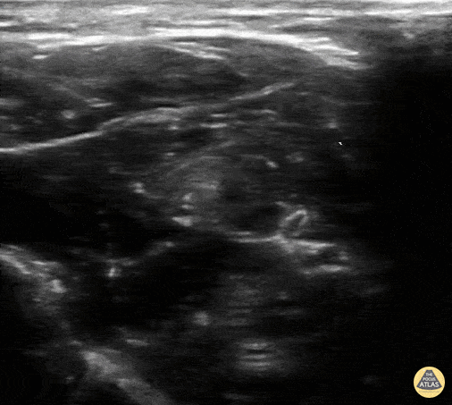 Peds-Nerve Blocks - Median Nerve Block