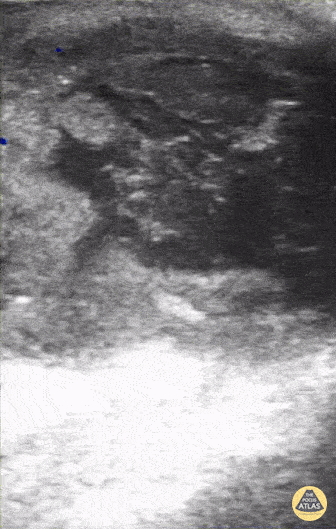 Peds-Soft Tissue - Pilonidal Abscess