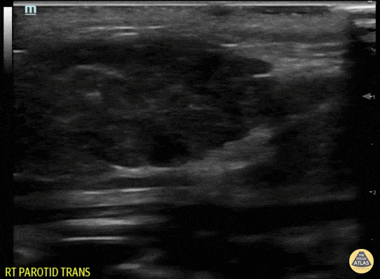 Peds-Soft Tissue - Parotitis