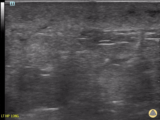 Peds-Soft Tissue - Cellulitis