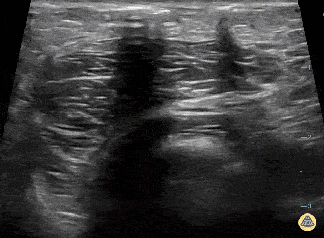 Peds-Soft Tissue - Necrotizing Fasciitis