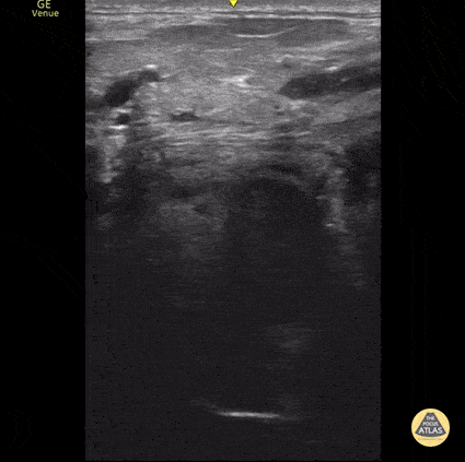 Peds-Soft Tissue - Transcervical Peritonsillar Abscess