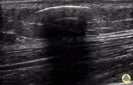 Peds-Soft Tissue - Glass Foreign Body