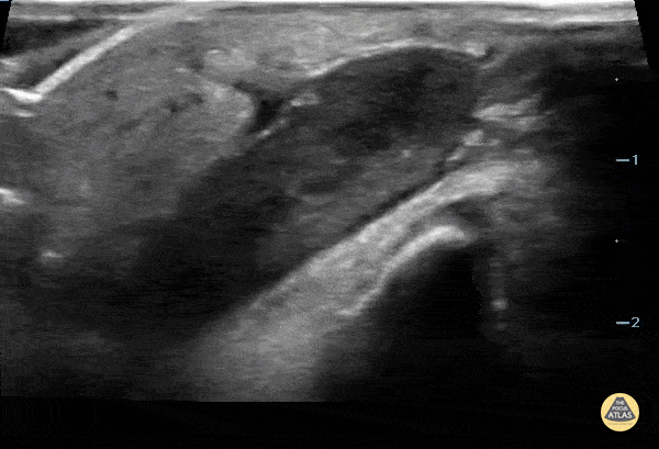 Peds-Soft Tissue - Retained Splinter