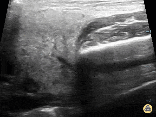 Peds-Soft Tissue - Parotitis