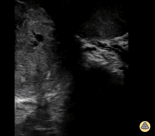 Peds-Genitourinary - Orchitis (1 of 2)