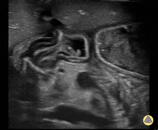 Peds-Genitourinary - Hernia into Scrotum