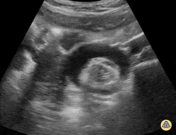 Peds-Genitourinary - Ovarian Teratomas