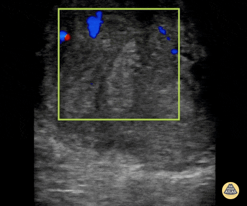 Peds-Genitourinary - Orchitis (2 of 2)