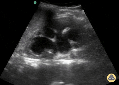 Peds-Genitourinary - Hydronephrosis