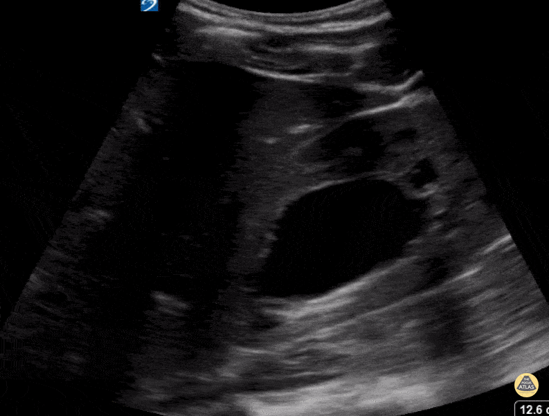 Peds-Genitourinary - Severe Hydronephrosis