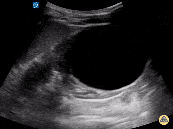 Peds-Genitourinary - Renal Cyst