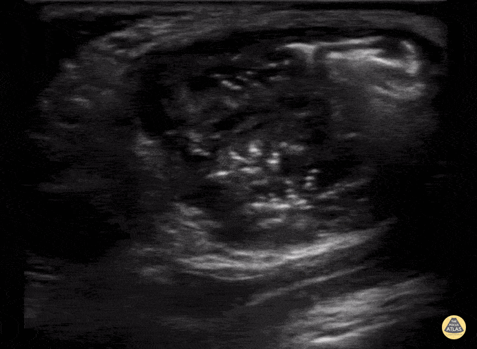 Peds-Genitourinary - Inguinal Hernia into Scrotum