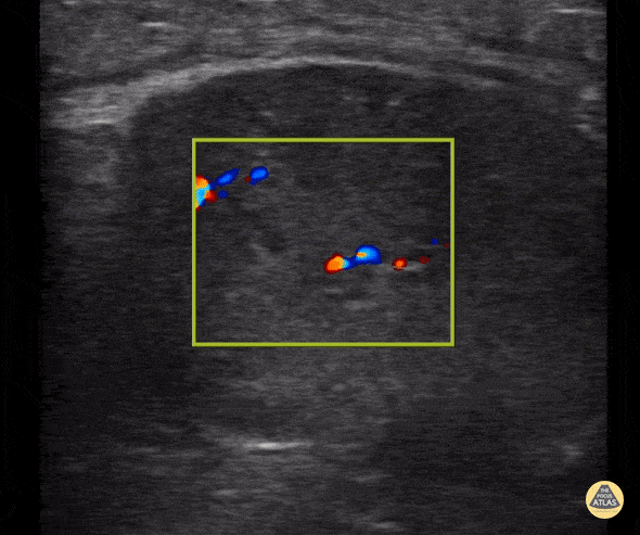 Peds-Genitourinary - Normal Testicle