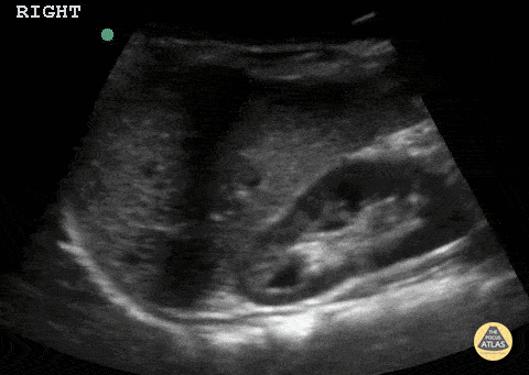Peds-Genitourinary - Normal Kidney