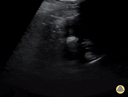 Peds-Genitourinary - Hematocolpos