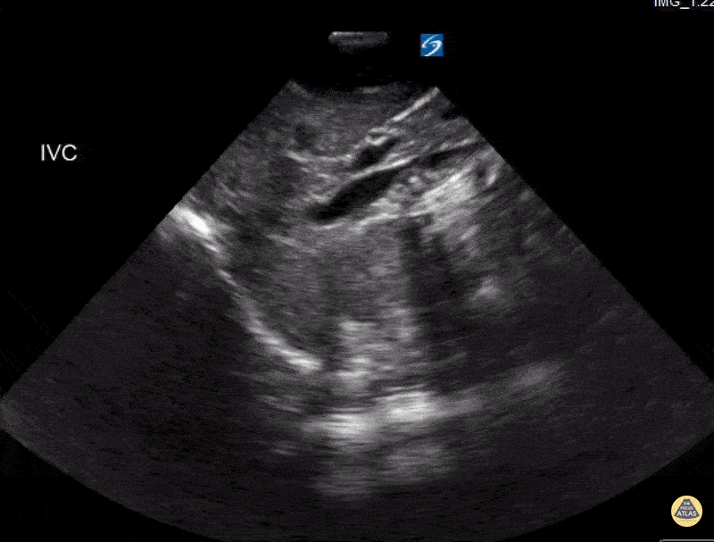 Peds-Cardiac - IVC Hypovolemia