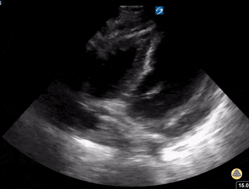 Peds-Cardiac - Pericardial effusion from lupus